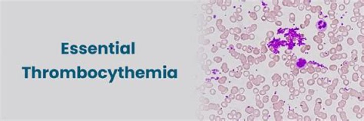 Unveiling The Secrets Of Essential Thrombocythemia: Celebrity Insights